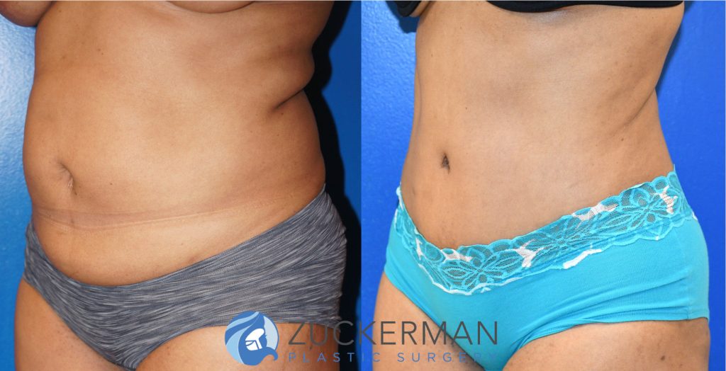 Tummy Tuck (abdominoplasty) by Dr. Zuckerman. Patient, female, 2 months postop. Liposuction of abdomen and flanks also performed. left oblique