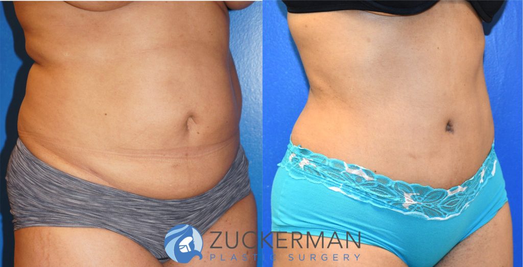 Tummy Tuck (abdominoplasty) by Dr. Zuckerman. Patient, female, 2 months postop. Liposuction of abdomen and flanks also performed. right oblique