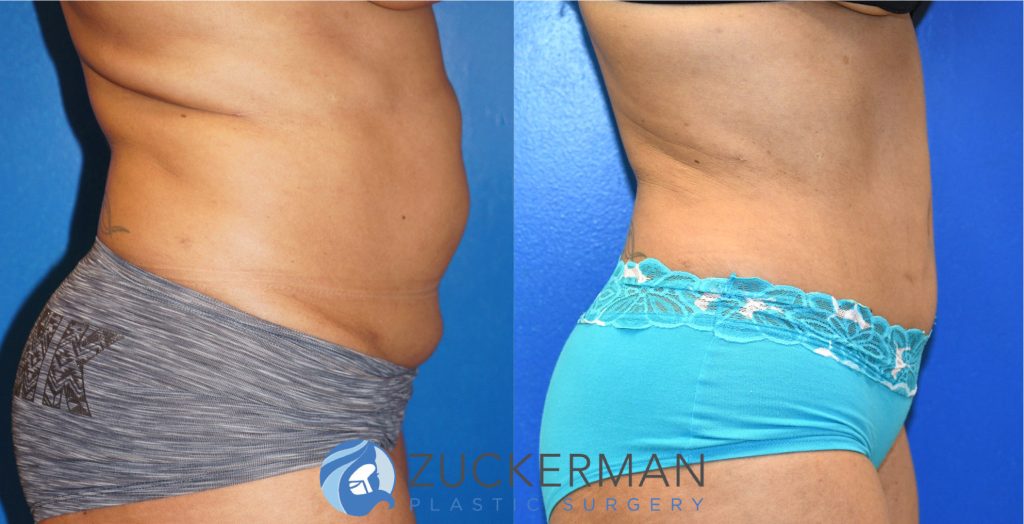 Tummy Tuck (abdominoplasty) by Dr. Zuckerman. Patient, female, 2 months postop. Liposuction of abdomen and flanks also performed. right profile