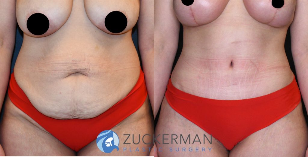 Tummy Tuck (abdominoplasty) by Dr. Zuckerman. Patient, female, 2 months postop. Liposuction of abdomen and flanks also performed. Patient lost 100lbs prior to surgery. frontal