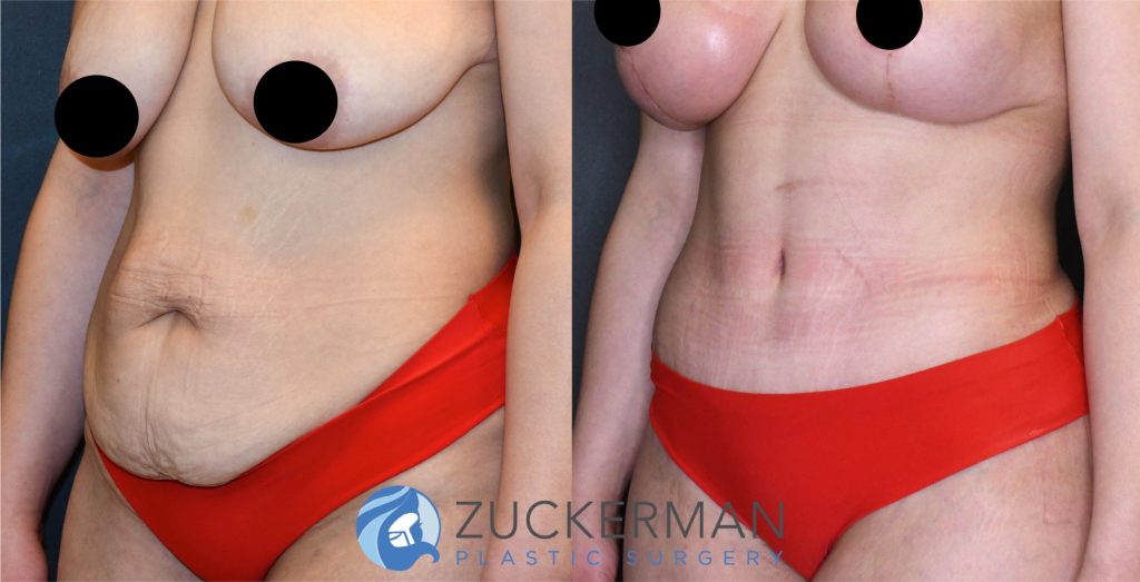 Tummy Tuck (abdominoplasty) by Dr. Zuckerman. Patient, female, 2 months postop. Liposuction of abdomen and flanks also performed. Patient lost 100lbs prior to surgery. left oblique