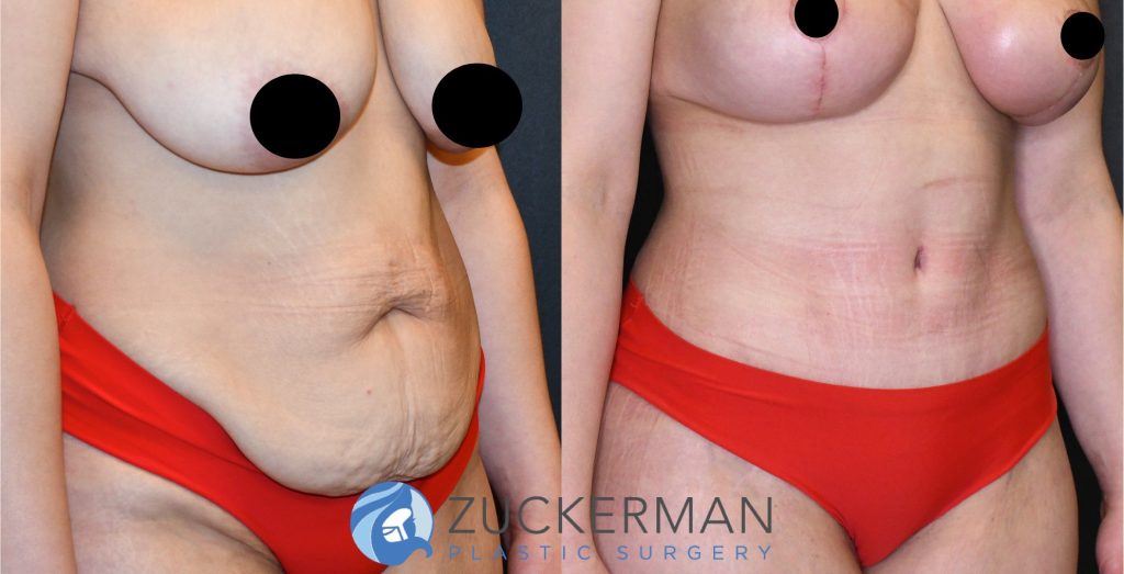 Tummy Tuck (abdominoplasty) by Dr. Zuckerman. Patient, female, 2 months postop. Liposuction of abdomen and flanks also performed. Patient lost 100lbs prior to surgery. right oblique