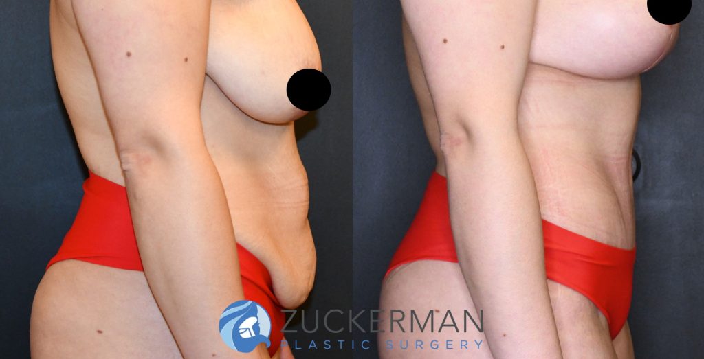 Tummy Tuck (abdominoplasty) by Dr. Zuckerman. Patient, female, 2 months postop. Liposuction of abdomen and flanks also performed. Patient lost 100lbs prior to surgery. right profile