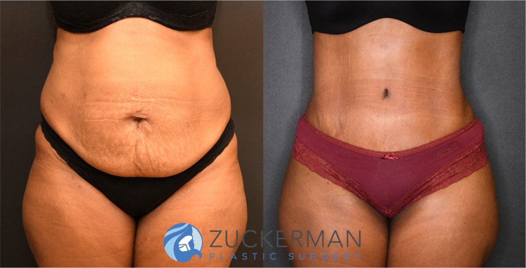 Tummy Tuck (abdominoplasty) by Dr. Zuckerman. Patient, female, 2 months postop. Liposuction of abdomen and flanks also performed. frontal