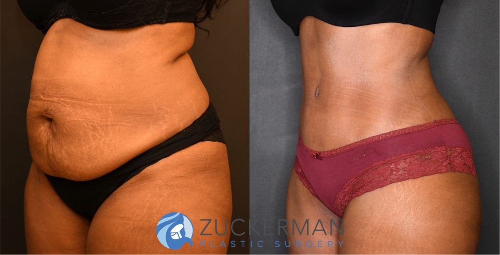 Tummy Tuck (abdominoplasty) by Dr. Zuckerman. Patient, female, 2 months postop. Liposuction of abdomen and flanks also performed. left oblique