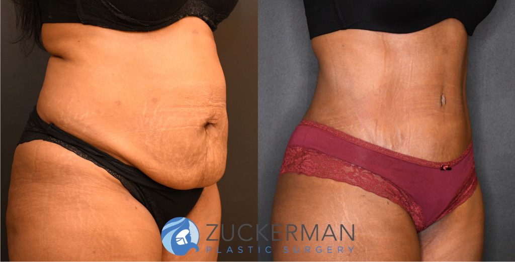 Tummy Tuck (abdominoplasty) by Dr. Zuckerman. Patient, female, 2 months postop. Liposuction of abdomen and flanks also performed. right oblique