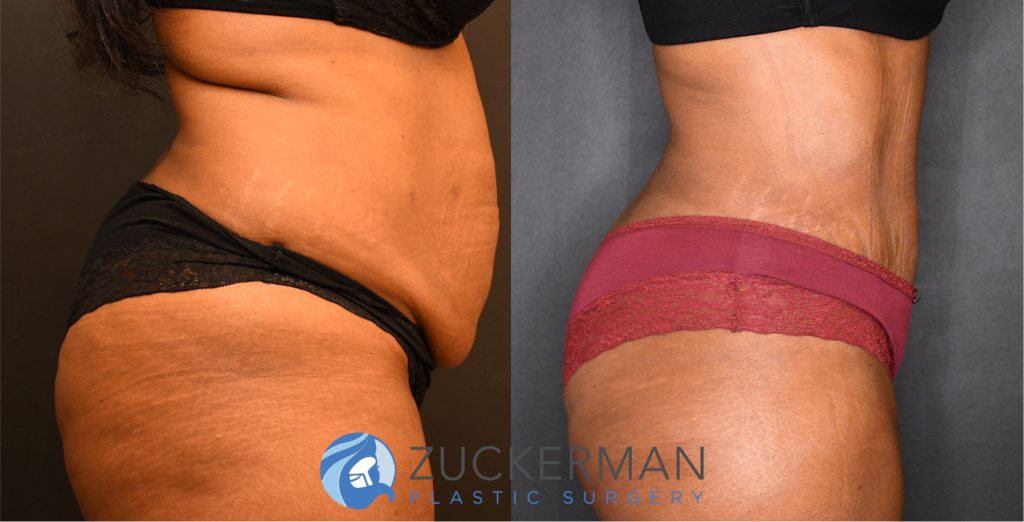 Tummy Tuck (abdominoplasty) by Dr. Zuckerman. Patient, female, 2 months postop. Liposuction of abdomen and flanks also performed. right profile