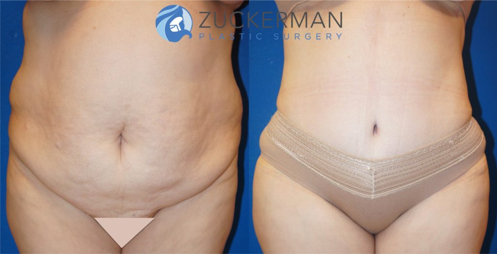 Tummy Tuck (abdominoplasty) by Dr. Zuckerman. Patient, female, 1 month postop. Approximately 4 liters of fat also removed via liposuction of abdomen and flanks. Note: not all patients of this BMI are good candidates for surgery. frontal