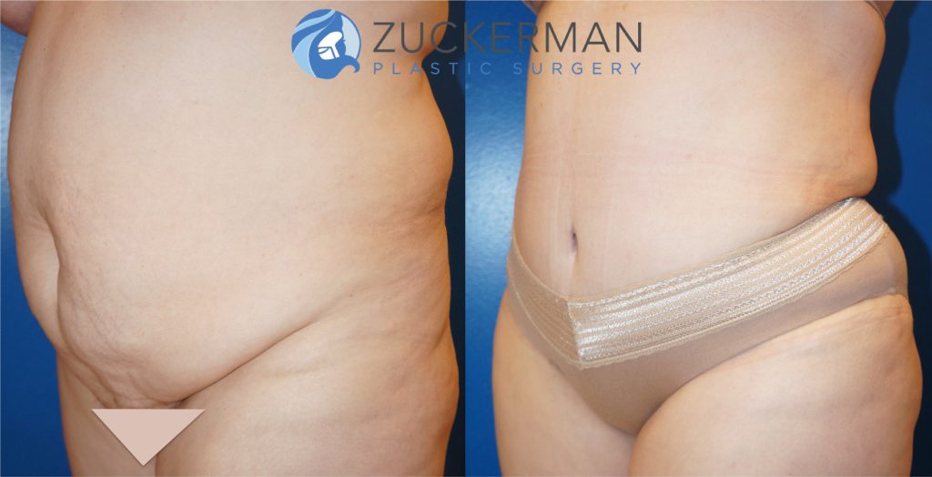 Tummy Tuck (abdominoplasty) by Dr. Zuckerman. Patient, female, 1 month postop. Approximately 4 liters of fat also removed via liposuction of abdomen and flanks. Note: not all patients of this BMI are good candidates for surgery. left oblique