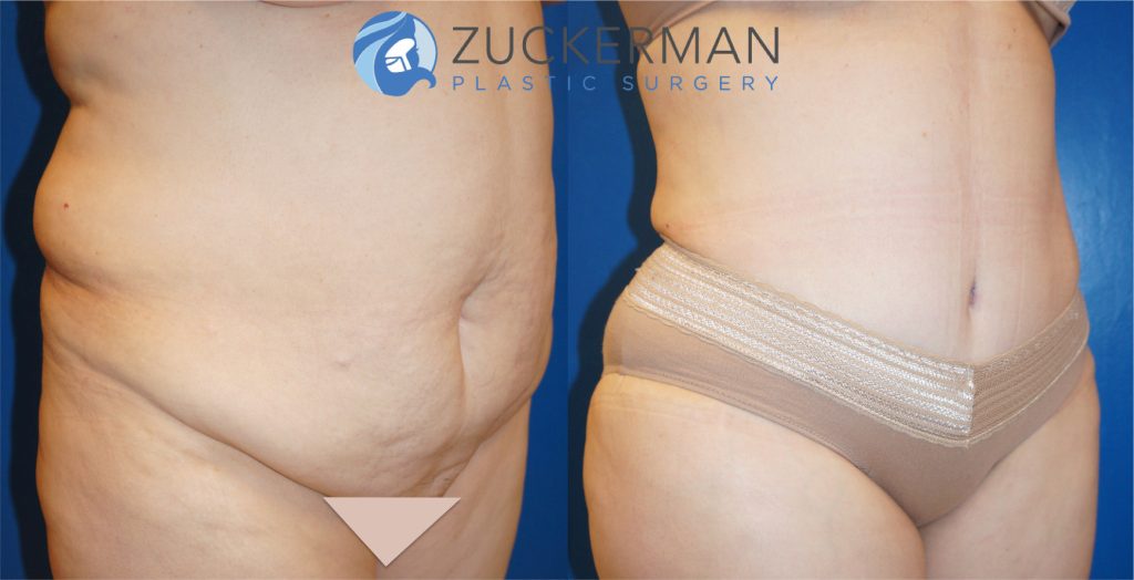 Tummy Tuck (abdominoplasty) by Dr. Zuckerman. Patient, female, 1 month postop. Approximately 4 liters of fat also removed via liposuction of abdomen and flanks. Note: not all patients of this BMI are good candidates for surgery. right oblique