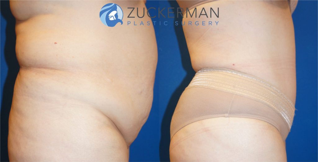 Tummy Tuck (abdominoplasty) by Dr. Zuckerman. Patient, female, 1 month postop. Approximately 4 liters of fat also removed via liposuction of abdomen and flanks. Note: not all patients of this BMI are good candidates for surgery. right profile