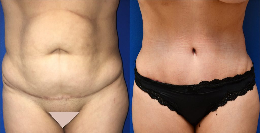 Revision tummy tuck (abdominoplasty) by Dr. Zuckerman. Patient, female, 1.5 months postop. Corrective surgery after prior poor quality tummy tuck. No pregnancy between first procedure and the corrective procedure. frontal