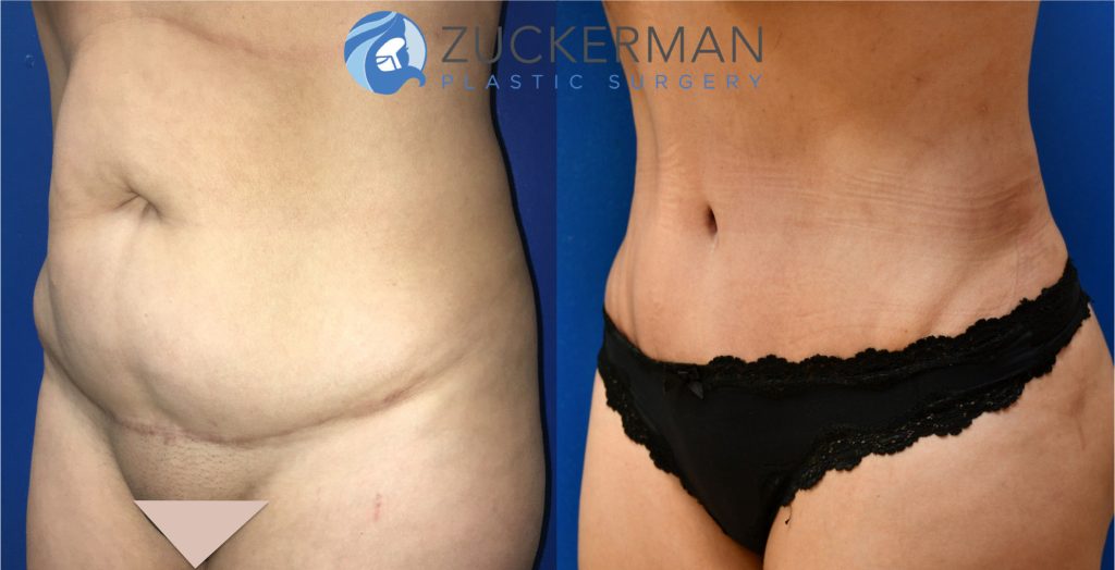 Revision tummy tuck (abdominoplasty) by Dr. Zuckerman. Patient, female, 1.5 months postop. Corrective surgery after prior poor quality tummy tuck. No pregnancy between first procedure and the corrective procedure. left oblique