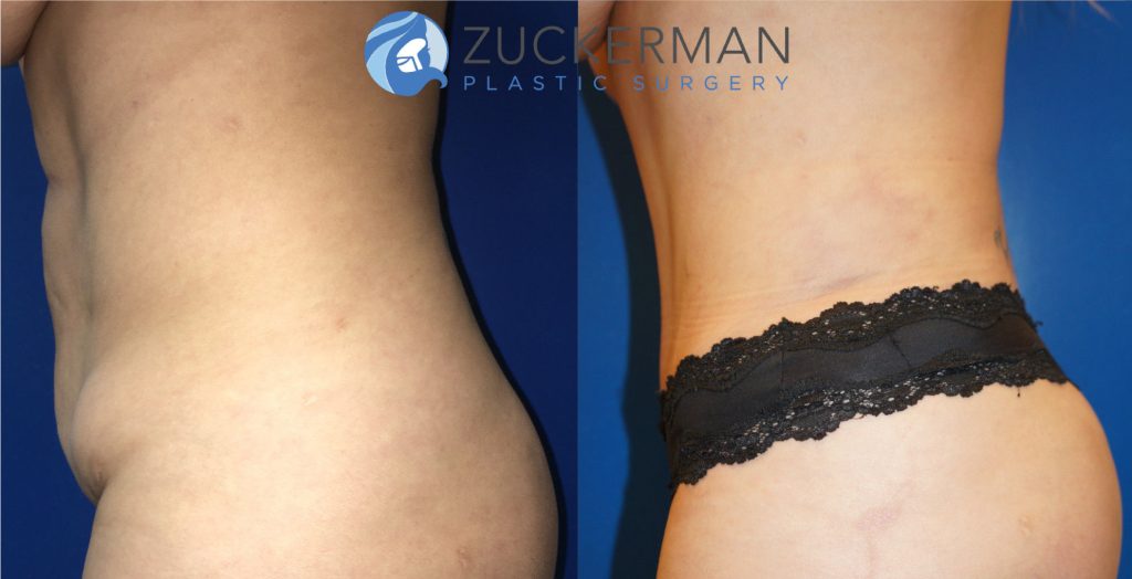 Revision tummy tuck (abdominoplasty) by Dr. Zuckerman. Patient, female, 1.5 months postop. Corrective surgery after prior poor quality tummy tuck. No pregnancy between first procedure and the corrective procedure. left profile