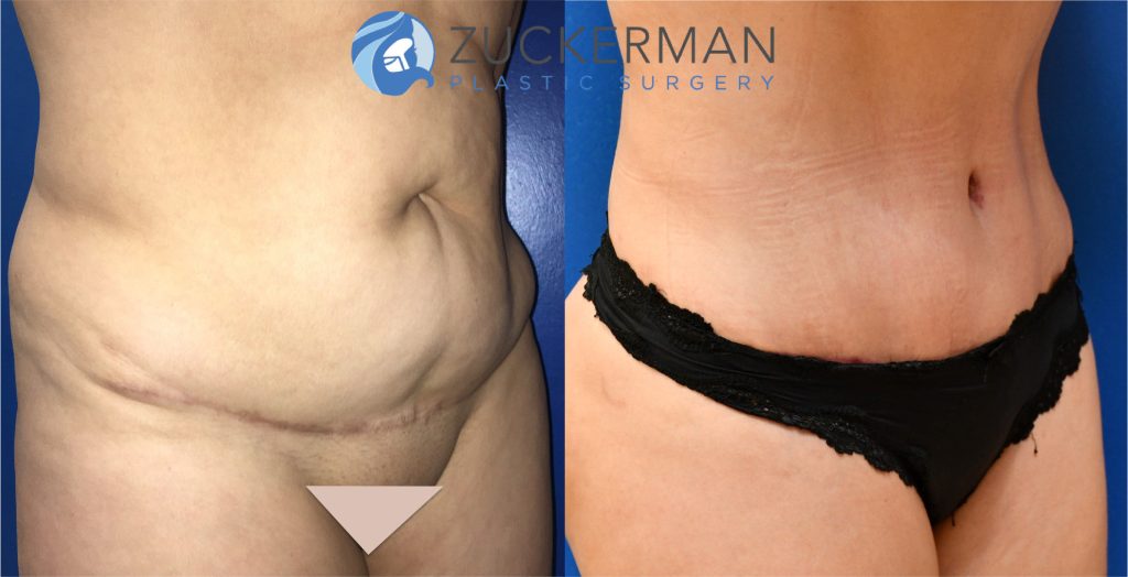 Revision tummy tuck (abdominoplasty) by Dr. Zuckerman. Patient, female, 1.5 months postop. Corrective surgery after prior poor quality tummy tuck. No pregnancy between first procedure and the corrective procedure. right oblique