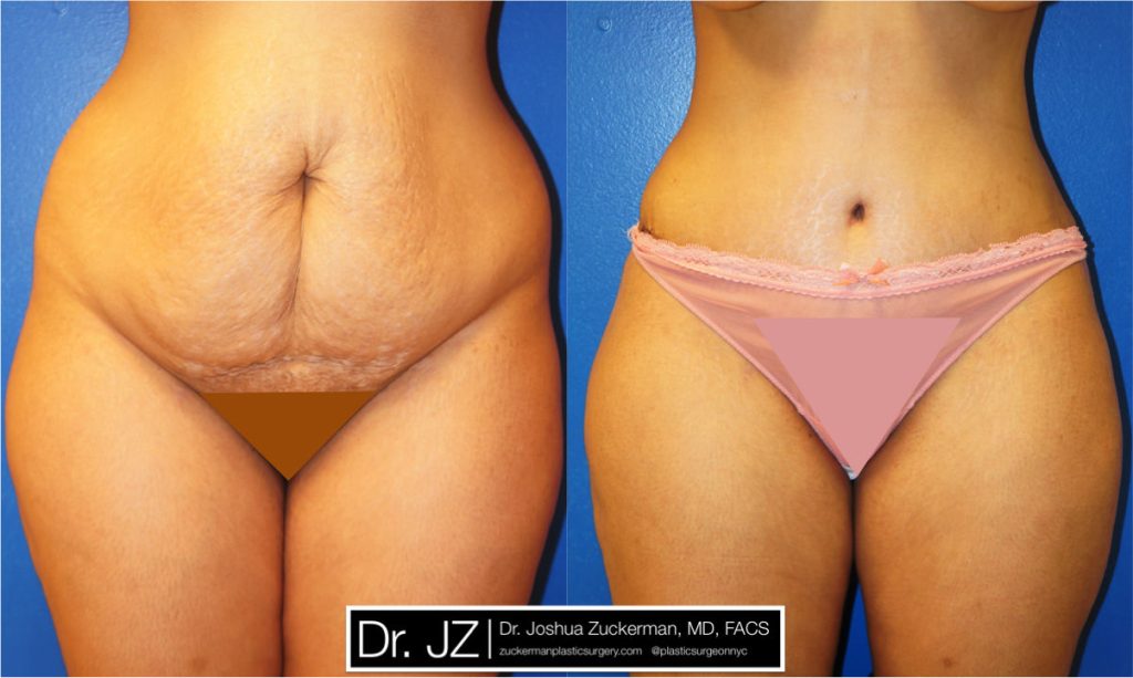 Tummy Tuck (abdominoplasty) by Dr. Zuckerman. Patient, female, 1 month postop. Liposuction of abdomen and flanks also performed. frontal