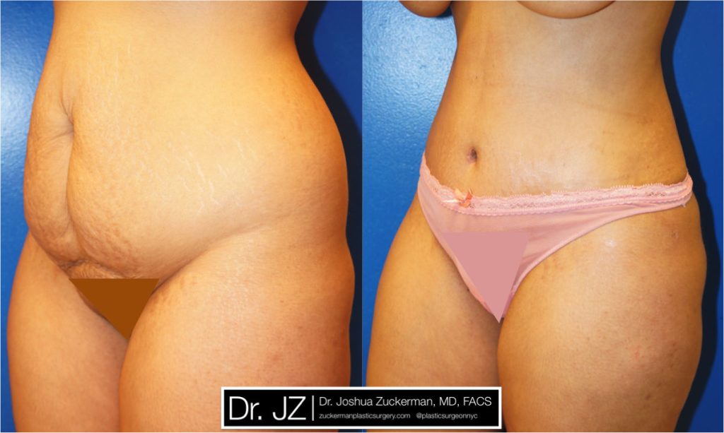 Tummy Tuck (abdominoplasty) by Dr. Zuckerman. Patient, female, 1 month postop. Liposuction of abdomen and flanks also performed. left oblique