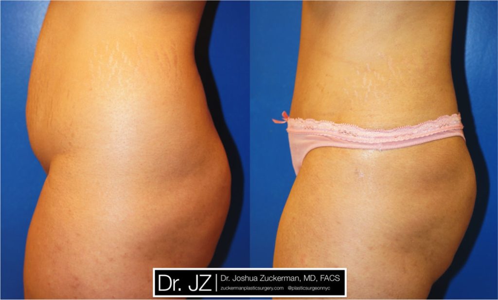 Tummy Tuck (abdominoplasty) by Dr. Zuckerman. Patient, female, 1 month postop. Liposuction of abdomen and flanks also performed. left profile