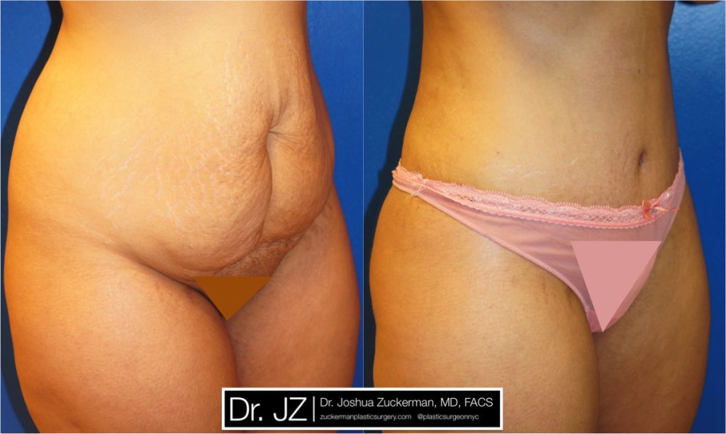 Tummy Tuck (abdominoplasty) by Dr. Zuckerman. Patient, female, 1 month postop. Liposuction of abdomen and flanks also performed. right oblique