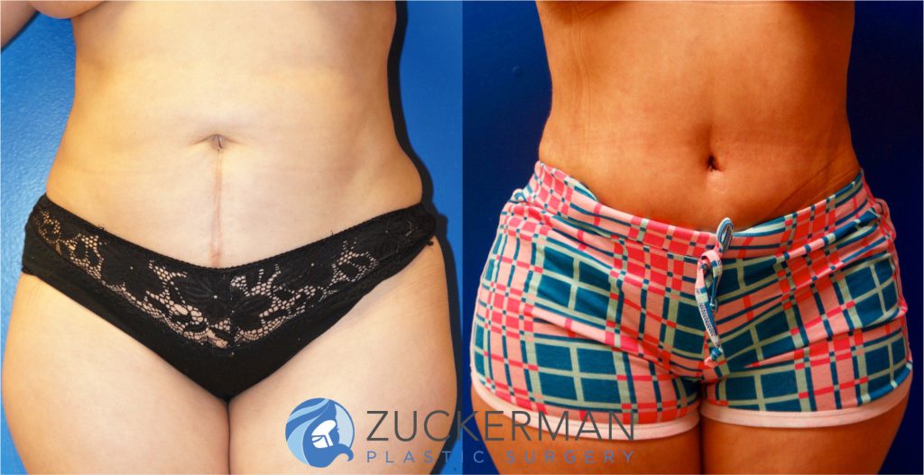 Tummy Tuck (abdominoplasty) by Dr. Zuckerman. Patient, female, 1 month postop. One liter of fat also removed via liposuction of abdomen and flanks. frontal