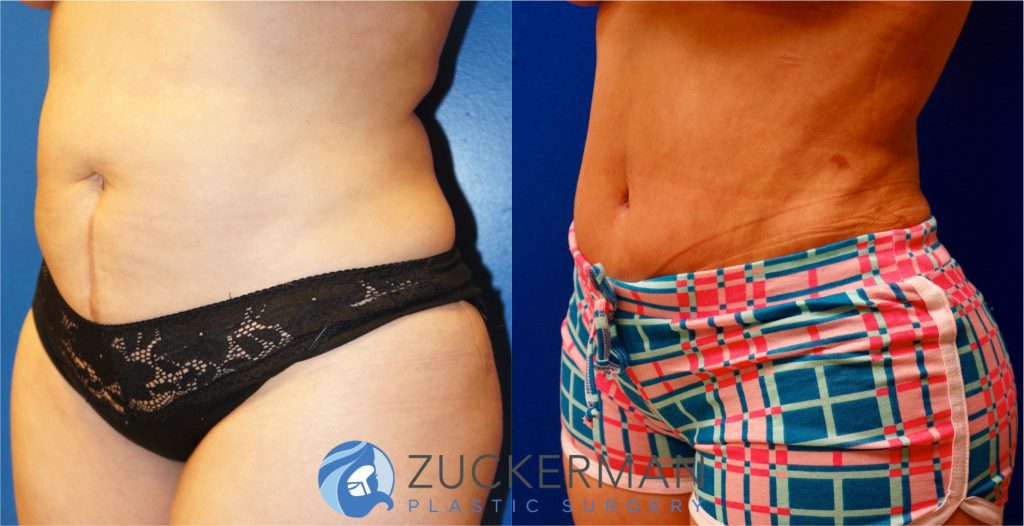 Tummy Tuck (abdominoplasty) by Dr. Zuckerman. Patient, female, 1 month postop. One liter of fat also removed via liposuction of abdomen and flanks. left oblique