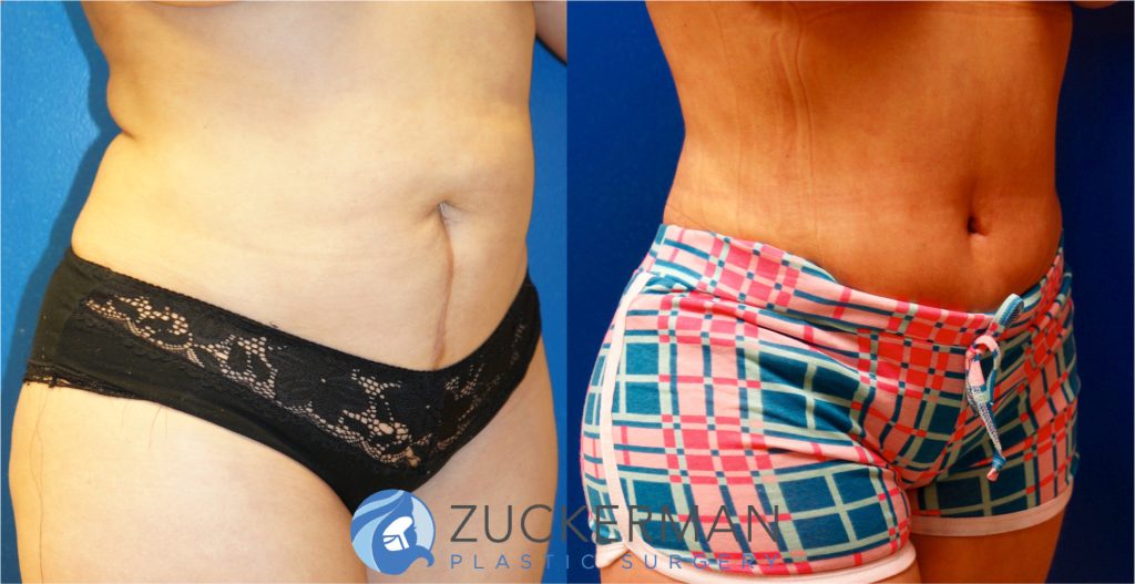 Tummy Tuck (abdominoplasty) by Dr. Zuckerman. Patient, female, 1 month postop. One liter of fat also removed via liposuction of abdomen and flanks. right oblique