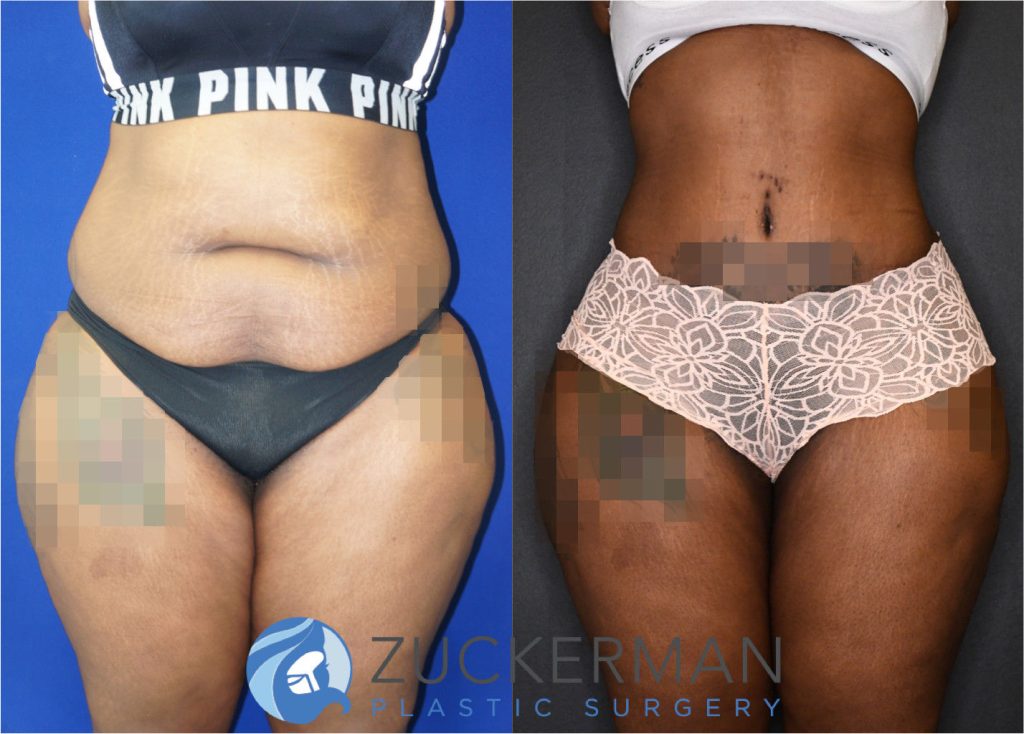 Tummy Tuck (abdominoplasty) by Dr. Zuckerman. Patient, female, 8 months postop. Approximately 4 liters of fat also removed via liposuction of abdomen and flanks. Fat grafting to the buttocks performed as well. frontal