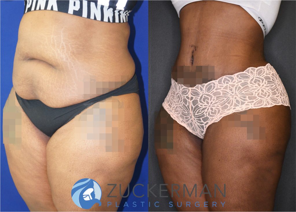 Tummy Tuck (abdominoplasty) by Dr. Zuckerman. Patient, female, 8 months postop. Approximately 4 liters of fat also removed via liposuction of abdomen and flanks. Fat grafting to the buttocks performed as well. oblique