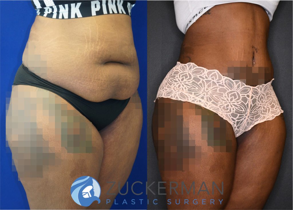 Tummy Tuck (abdominoplasty) by Dr. Zuckerman. Patient, female, 8 months postop. Approximately 4 liters of fat also removed via liposuction of abdomen and flanks. Fat grafting to the buttocks performed as well. right oblique