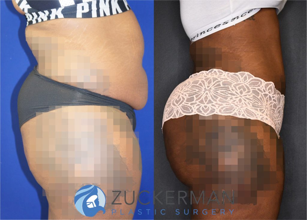 Tummy Tuck (abdominoplasty) by Dr. Zuckerman. Patient, female, 8 months postop. Approximately 4 liters of fat also removed via liposuction of abdomen and flanks. Fat grafting to the buttocks performed as well. right profile