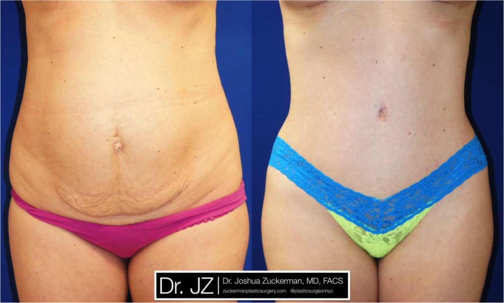 Tummy Tuck (abdominoplasty) by Dr. Zuckerman. Patient, female, 1 month postop. Approximately 2 liters of fat also removed via liposuction of abdomen and flanks. frontal