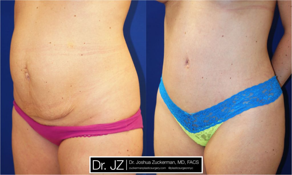 Tummy Tuck (abdominoplasty) by Dr. Zuckerman. Patient, female, 1 month postop. Approximately 2 liters of fat also removed via liposuction of abdomen and flanks. left oblique