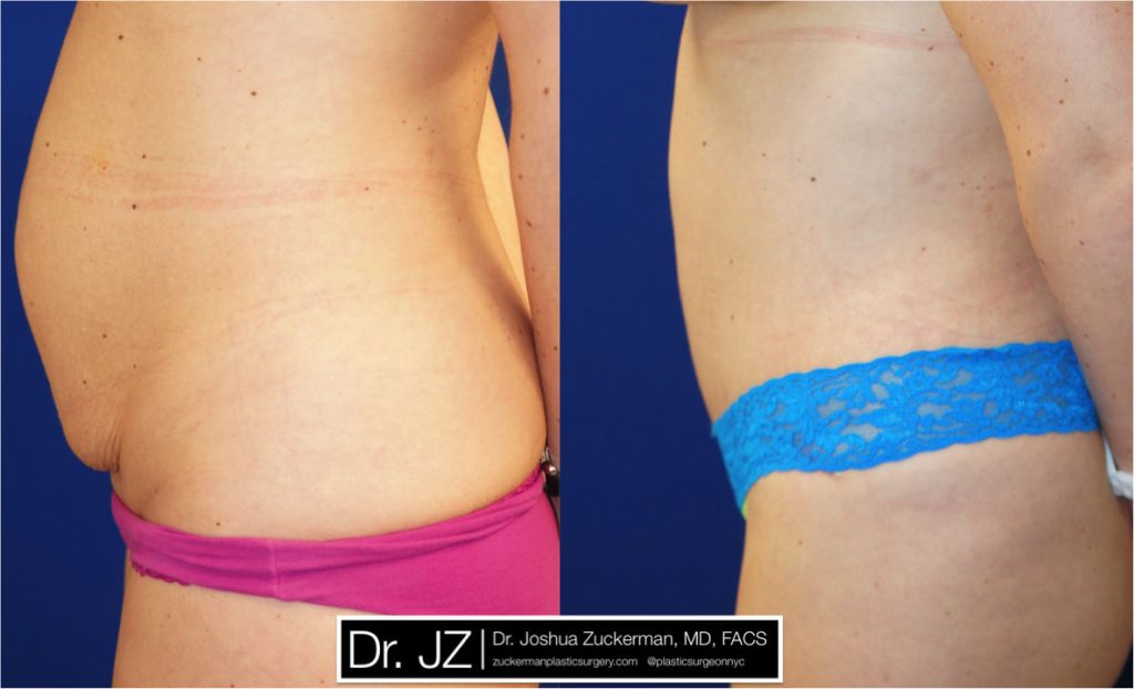 Tummy Tuck (abdominoplasty) by Dr. Zuckerman. Patient, female, 1 month postop. Approximately 2 liters of fat also removed via liposuction of abdomen and flanks. left profile