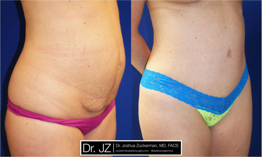 Tummy Tuck (abdominoplasty) by Dr. Zuckerman. Patient, female, 1 month postop. Approximately 2 liters of fat also removed via liposuction of abdomen and flanks. right oblique