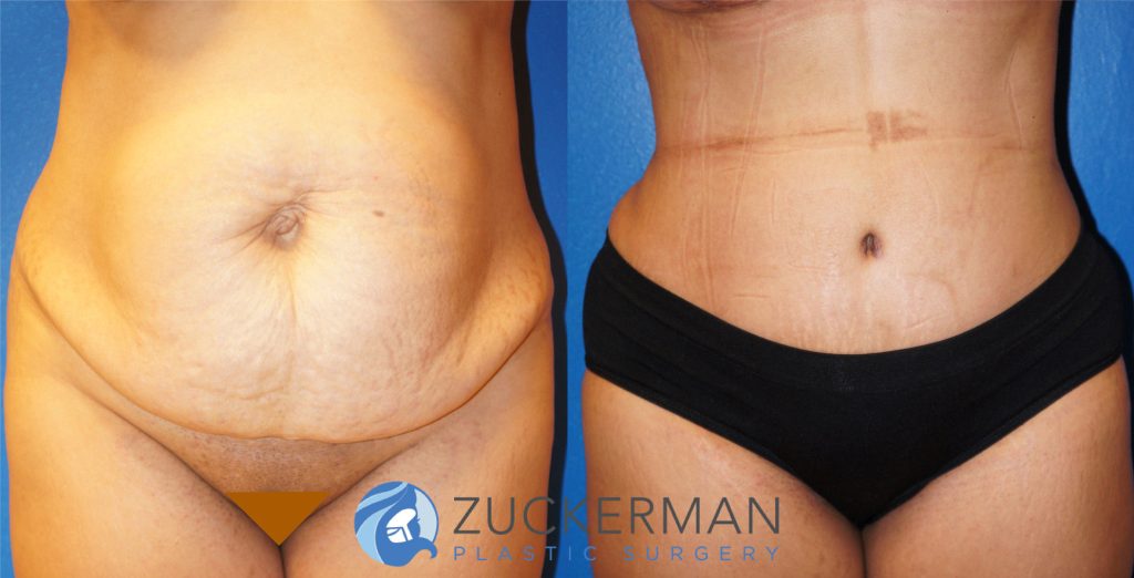 Tummy Tuck (abdominoplasty) by Dr. Zuckerman. Patient, female, 1 month postop. One liter of fat also removed via liposuction of abdomen and flanks. frontal