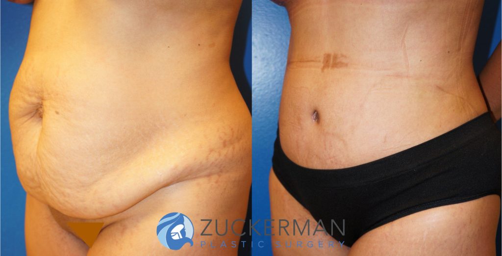 Tummy Tuck (abdominoplasty) by Dr. Zuckerman. Patient, female, 1 month postop. One liter of fat also removed via liposuction of abdomen and flanks. left oblique