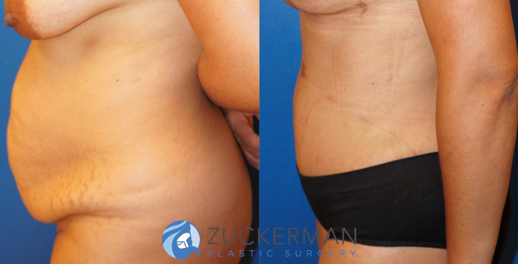 Tummy Tuck (abdominoplasty) by Dr. Zuckerman. Patient, female, 1 month postop. One liter of fat also removed via liposuction of abdomen and flanks. left profile