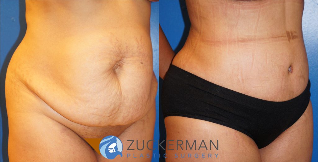 Tummy Tuck (abdominoplasty) by Dr. Zuckerman. Patient, female, 1 month postop. One liter of fat also removed via liposuction of abdomen and flanks. right oblique