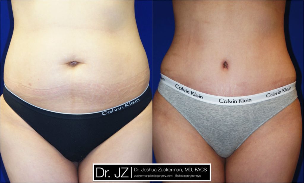 Tummy Tuck (abdominoplasty) by Dr. Zuckerman. Patient, female, 2 months postop. Liposuction of abdomen and flanks also performed. frontal