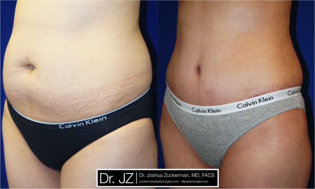 Tummy Tuck (abdominoplasty) by Dr. Zuckerman. Patient, female, 2 months postop. Liposuction of abdomen and flanks also performed. left oblique