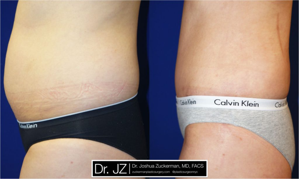 Tummy Tuck (abdominoplasty) by Dr. Zuckerman. Patient, female, 2 months postop. Liposuction of abdomen and flanks also performed. left profile