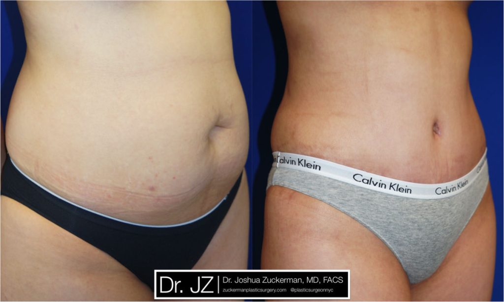 Tummy Tuck (abdominoplasty) by Dr. Zuckerman. Patient, female, 2 months postop. Liposuction of abdomen and flanks also performed. right oblique