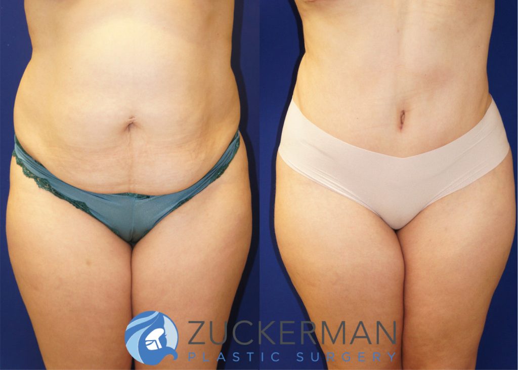 Tummy Tuck (abdominoplasty) by Dr. Zuckerman. Patient, female, 4 months postop. Approximately 4 liters of fat also removed via liposuction of abdomen and flanks. again frontal