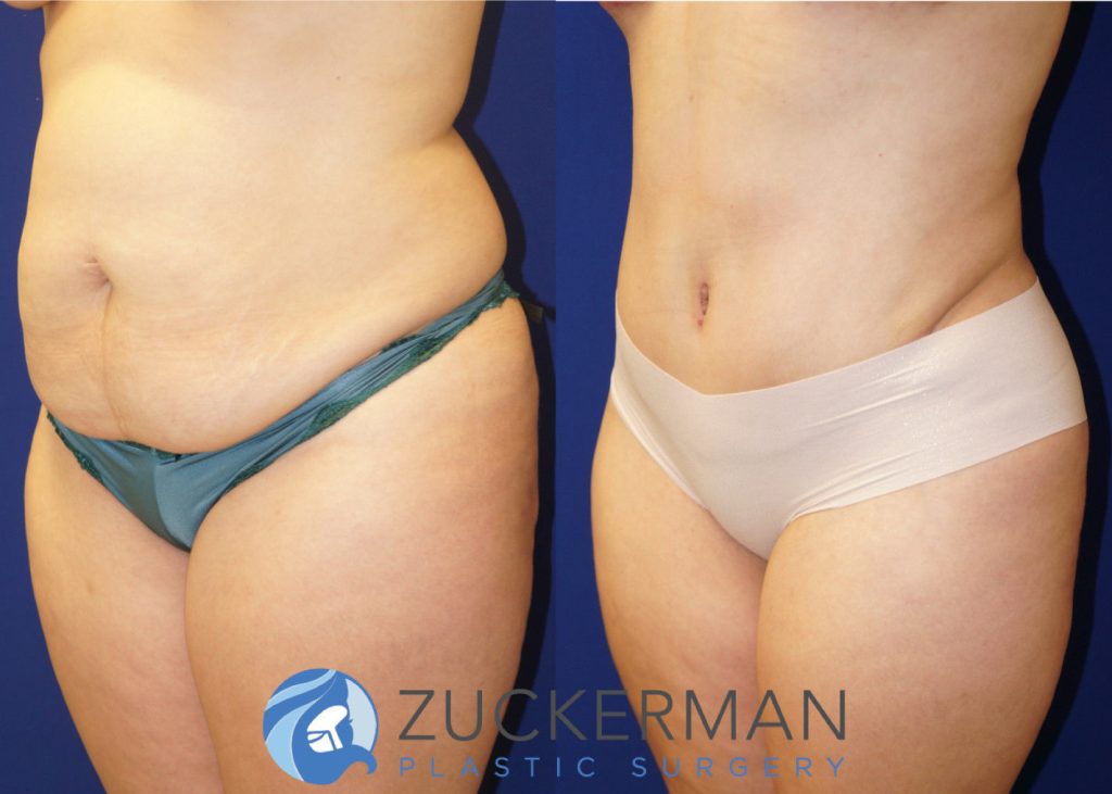 Tummy Tuck (abdominoplasty) by Dr. Zuckerman. Patient, female, 4 months postop. Approximately 4 liters of fat also removed via liposuction of abdomen and flanks. left oblique