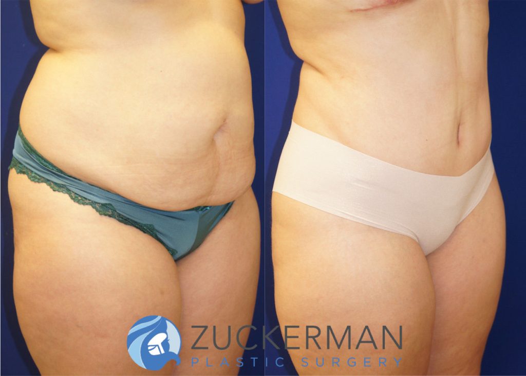 Tummy Tuck (abdominoplasty) by Dr. Zuckerman. Patient, female, 4 months postop. Approximately 4 liters of fat also removed via liposuction of abdomen and flanks. right oblique