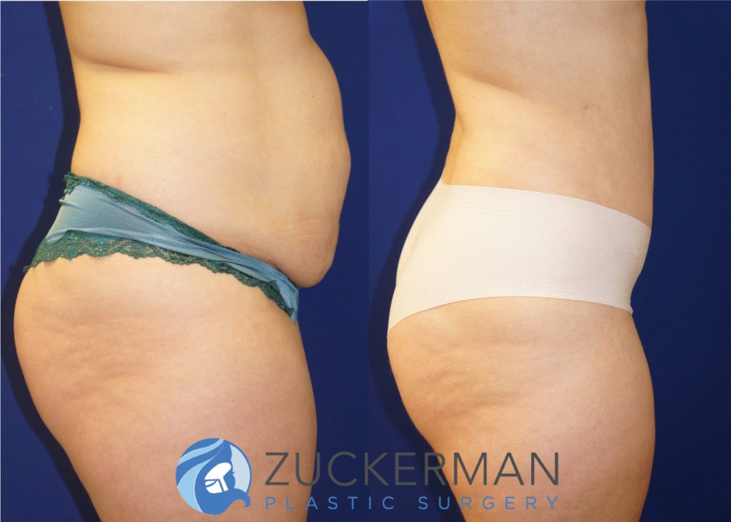 Tummy Tuck (abdominoplasty) by Dr. Zuckerman. Patient, female, 4 months postop. Approximately 4 liters of fat also removed via liposuction of abdomen and flanks. right profile