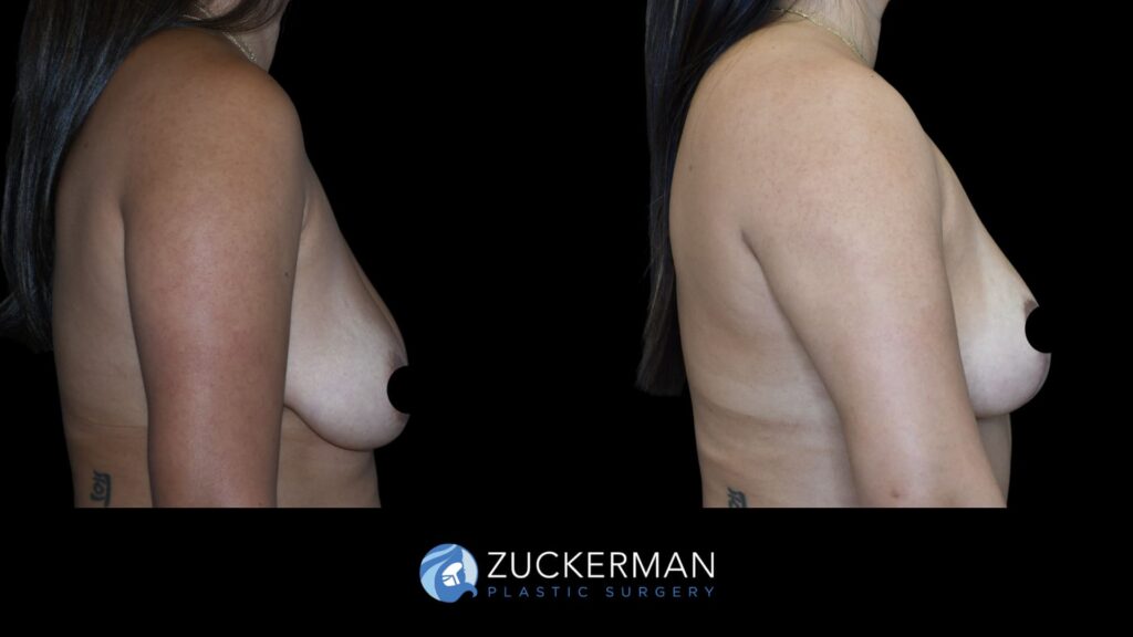 Patent before and after Mastopexy | Zuckerman Plastic Surgery