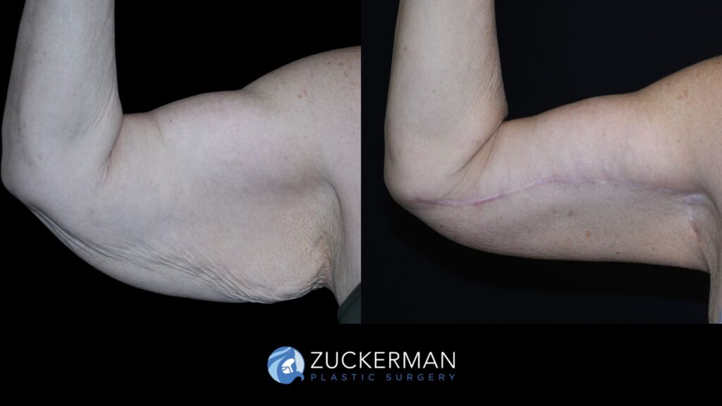 Arm lift (brachioplasty) by Dr. Zuckerman – before & 3 months after surgery