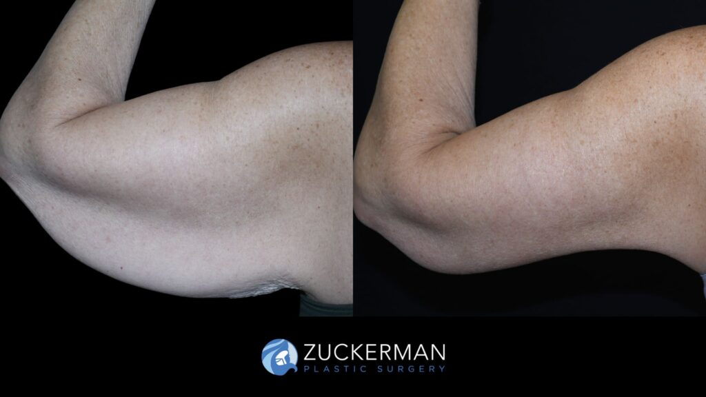 Arm lift (brachioplasty) by Dr. Zuckerman – before & 3 months after surgery