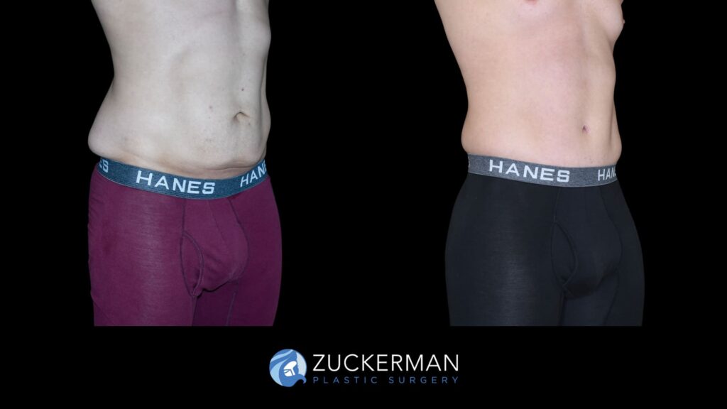 Patient before and after Circumferential Lift | Zuckerman Plastic Surgery